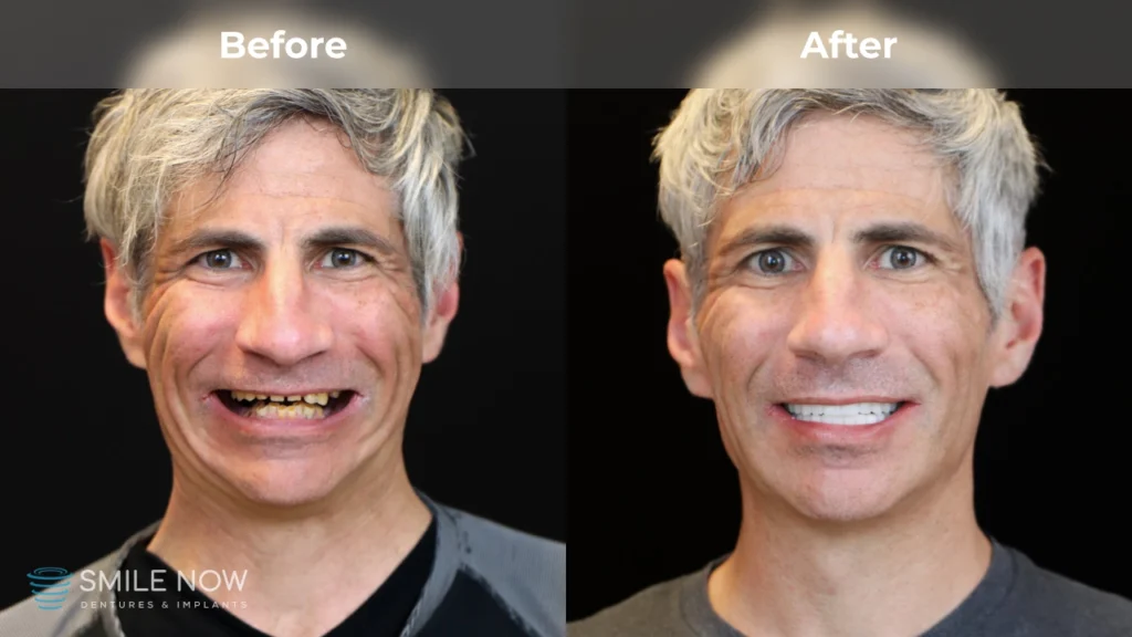 Before and after dental implants in Portland, OR at Smile Now Portland Dentures and Implants